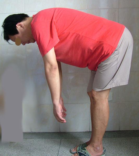 沈阳保髋强直医院说强直的危害表现