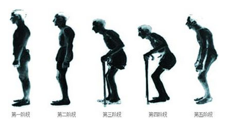 沈阳保髋强直医院解说疾病症状